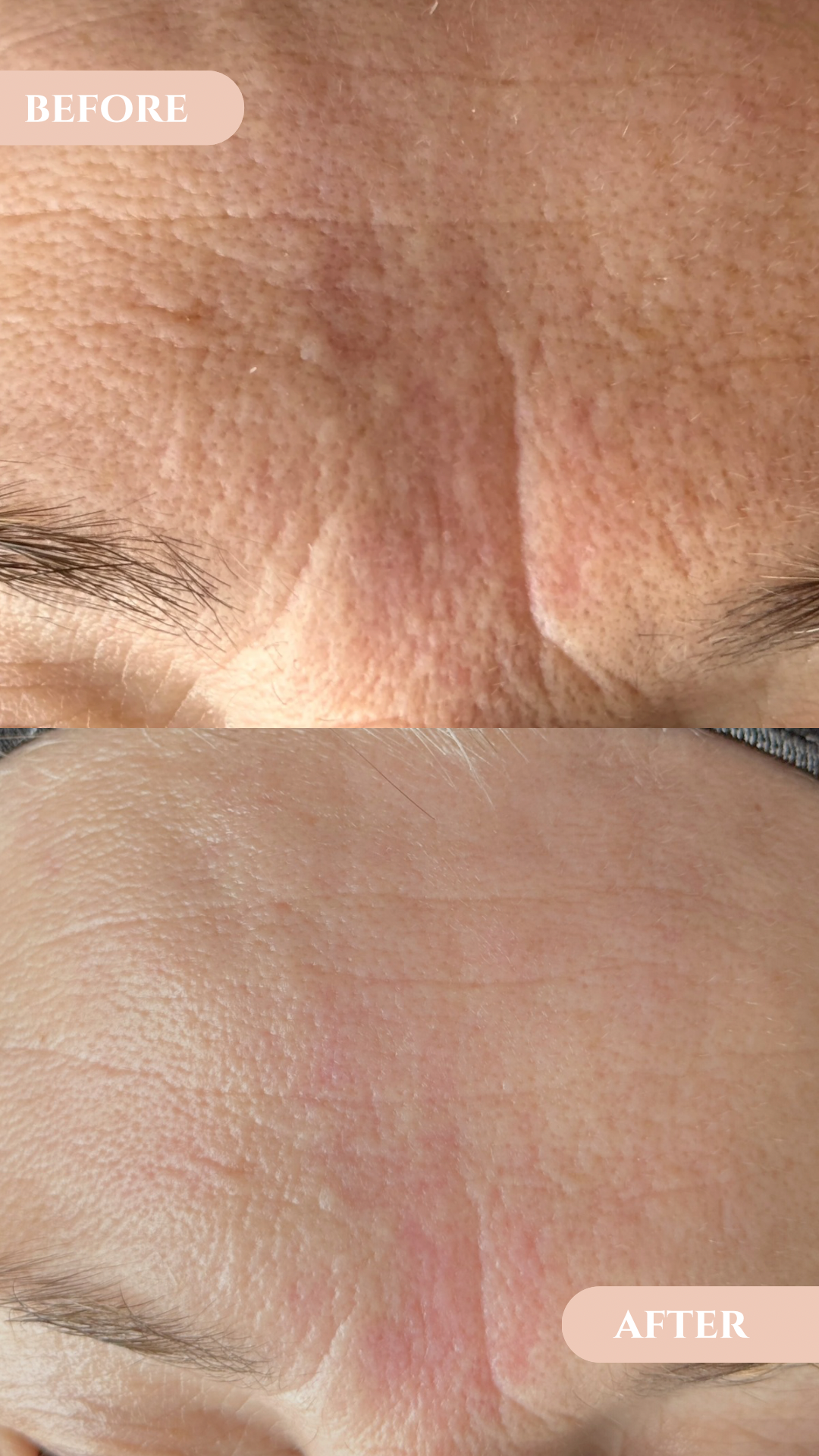 Multi-Vita tretman – trenutni sjaj kože ili dugoročna regeneracija? (realni rezultati)