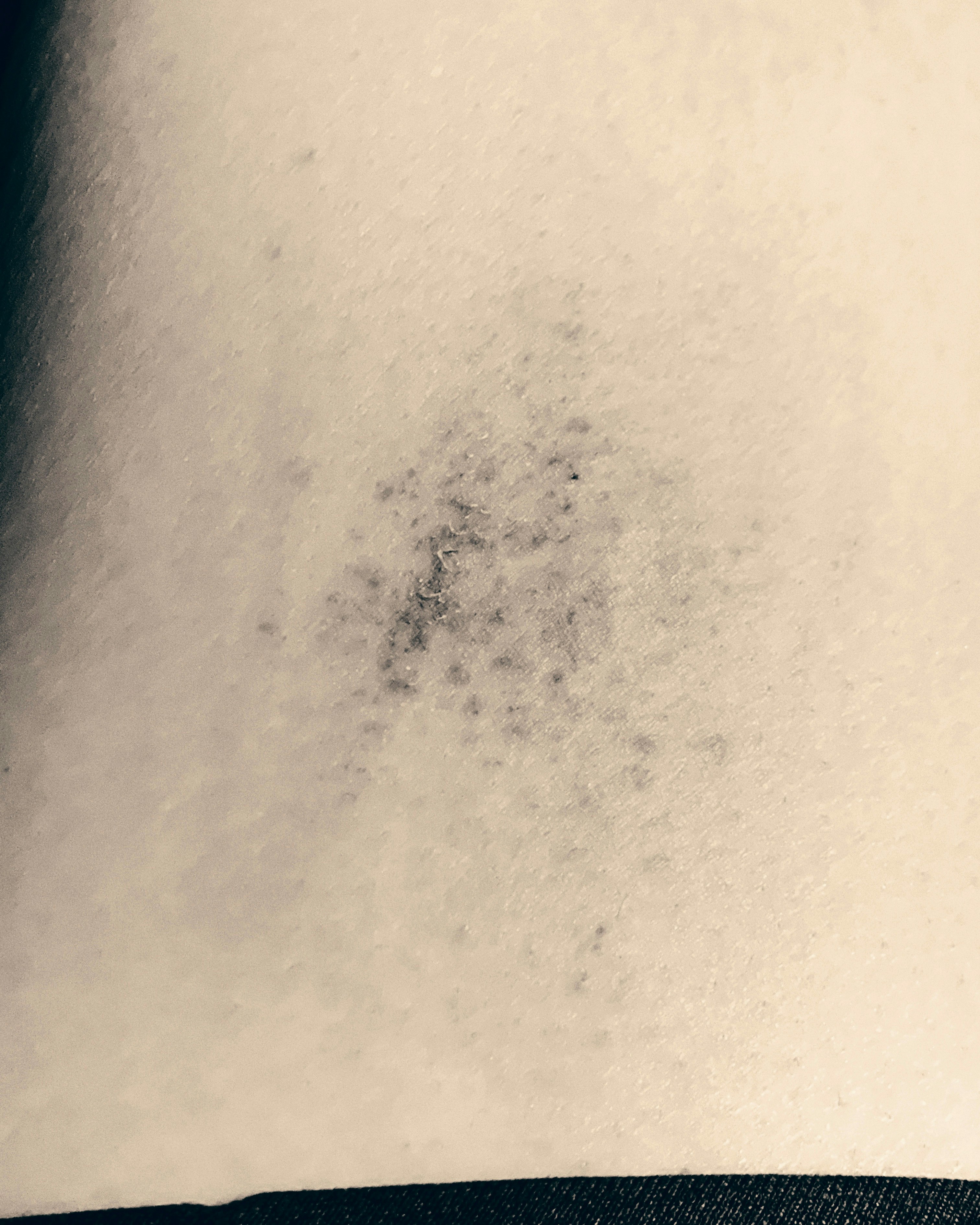 Zašto laserska epilacija nekad ne daje rezultate